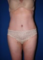 Tummy Tuck
