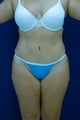 Tummy Tuck and lipo to flanks