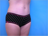 Tummy Tuck