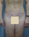 Tummy Tuck