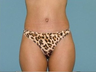Tummy Tuck