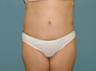 Tummy Tuck