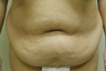 Tummy Tuck