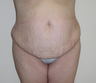 Tummy Tuck