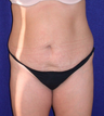 Tummy Tuck (abdominoplasty)