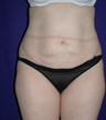 Tummy Tuck