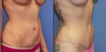 Abdominoplasty