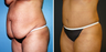 Tummy Tuck (Abdominoplasty) with Liposuction