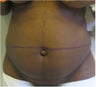 Tummy Tuck