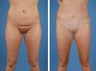Liposuction and mini tummy tuck