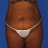 Tummy Tuck