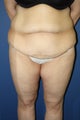 Abdominoplasty with suction-assisted lipectomy