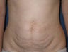 Tummy tuck