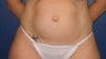 Tummy tuck