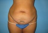 tummy tuck