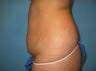 tummy tuck