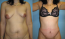 Tummy Tuck