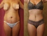 Tummy Tuck