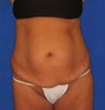 Tummy Tuck