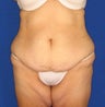 Tummy Tuck