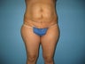 tummy tuck
