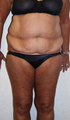 Tummy Tuck