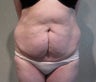 Tummy Tuck