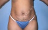 Tummy Tuck