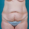 Tummy Tuck