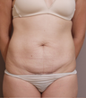 Tummy Tuck