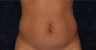 Tummy Tuck