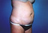 Full Tummy Tuck