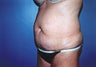 Full Tummy Tuck