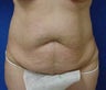 Abdominoplasty (tummy tuck) with Liposuction