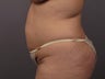 Tummy Tuck
