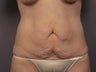 Tummy Tuck