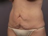 Tummy Tuck