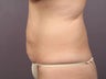 Tummy Tuck