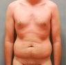 Abdominoplasty