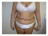 Tummy Tuck
