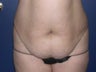Tummy Tuck