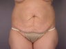 Tummy Tuck