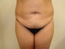 Tummy Tuck