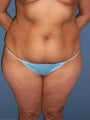 Tummy  Tuck