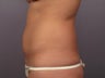 Tummy Tuck