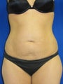 Abdominoplasty 