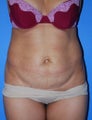 Tummy Tuck
