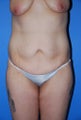 Abdominoplasty 