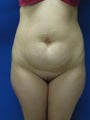 Tummy Tuck