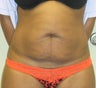 Tummy Tuck